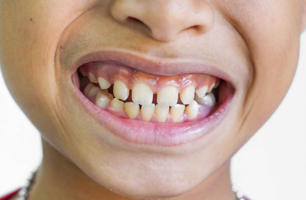 Juvenile teeth with gaps