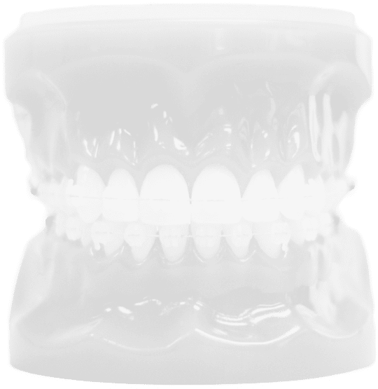 ceramic braces model