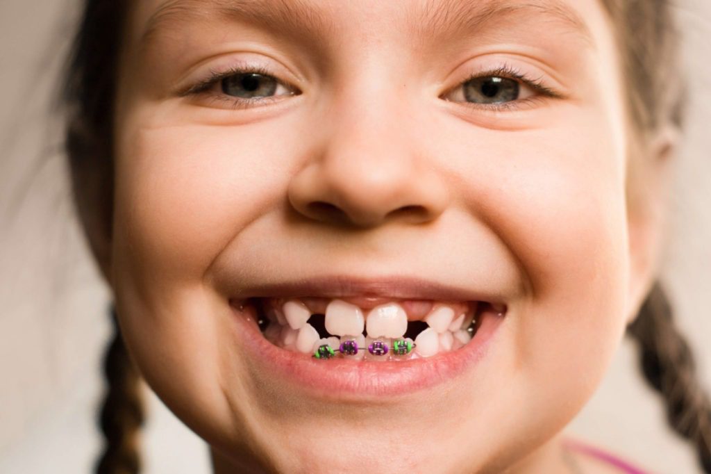 Young girl with braces on bottom teeth